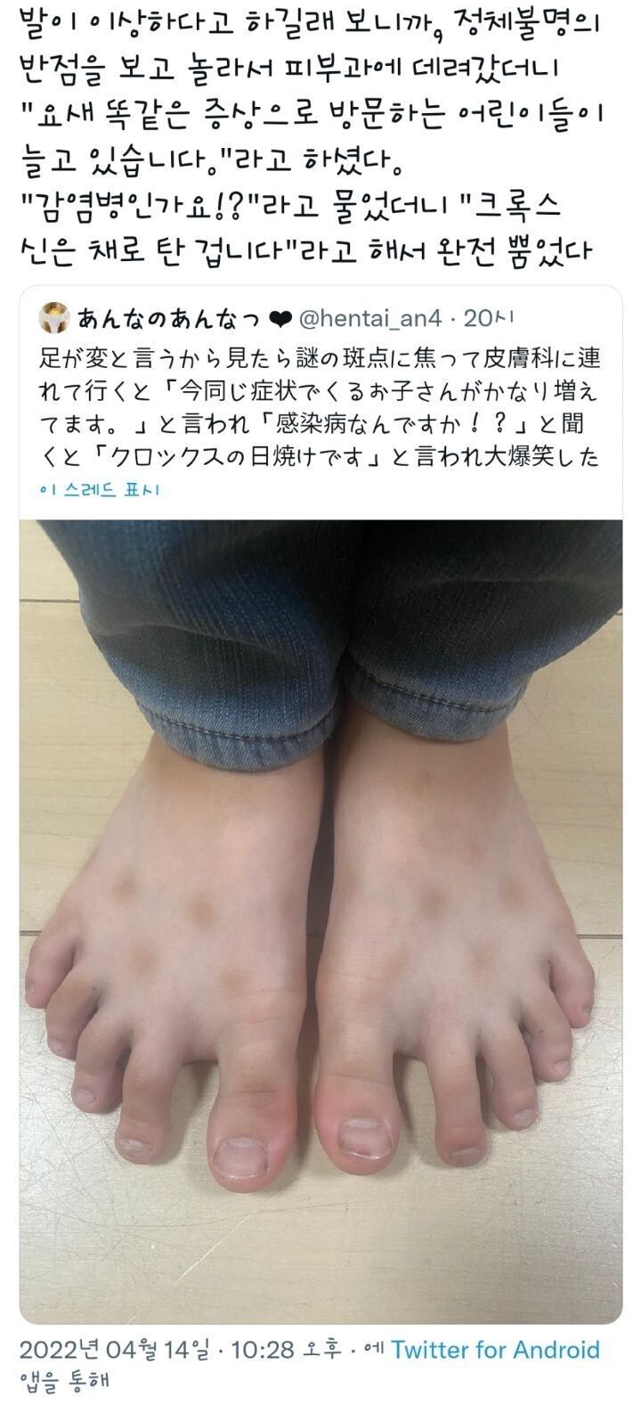 [유머] 어느날 갑자기 발등에 생긴 정체불명의 반점 -  와이드섬