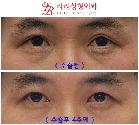 [유머] 쌍꺼플 제거 수술 -  와이드섬