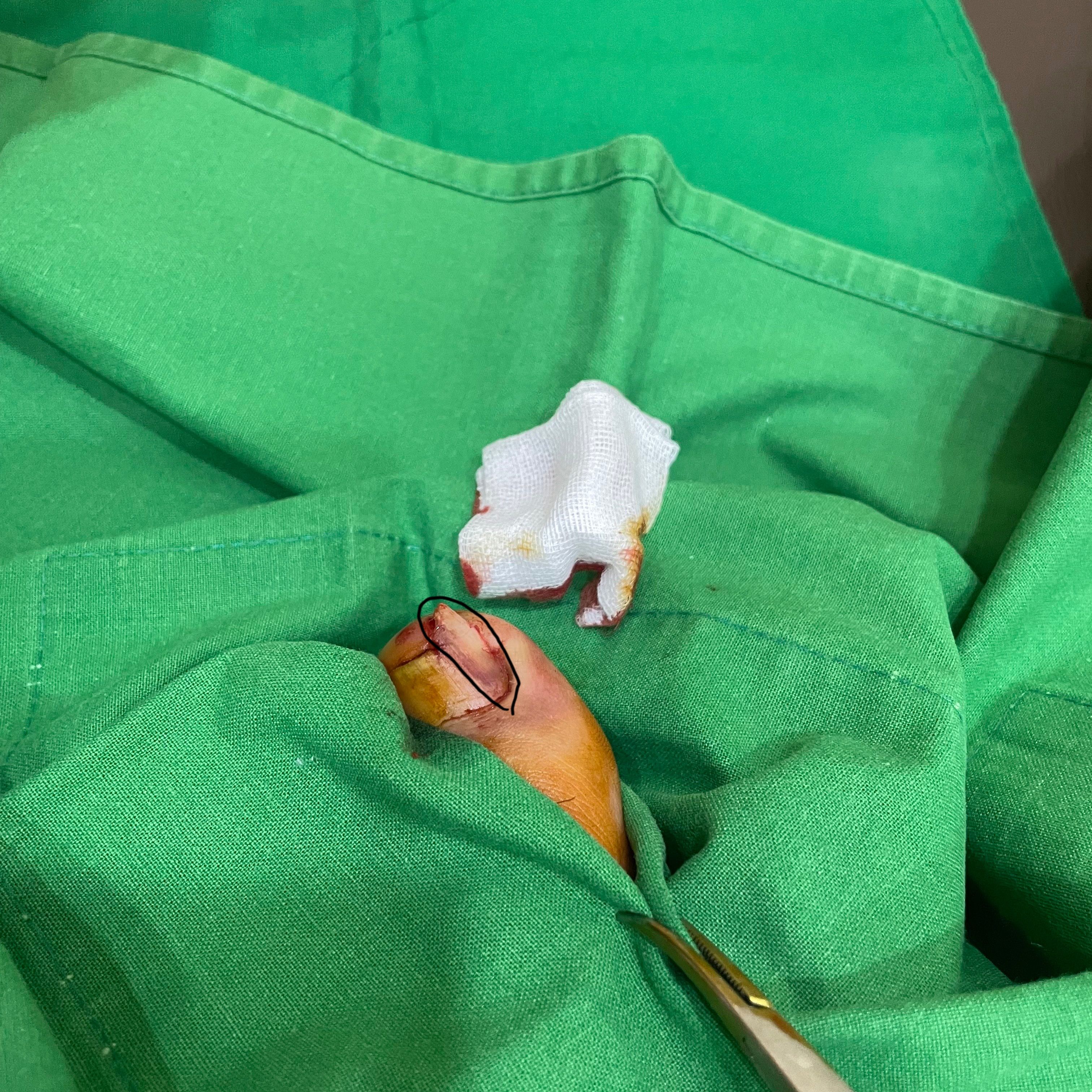 [유머] 내성발톱 완치기념 그때당시 수술사진ㅠㅠ(초극혐) -  와이드섬