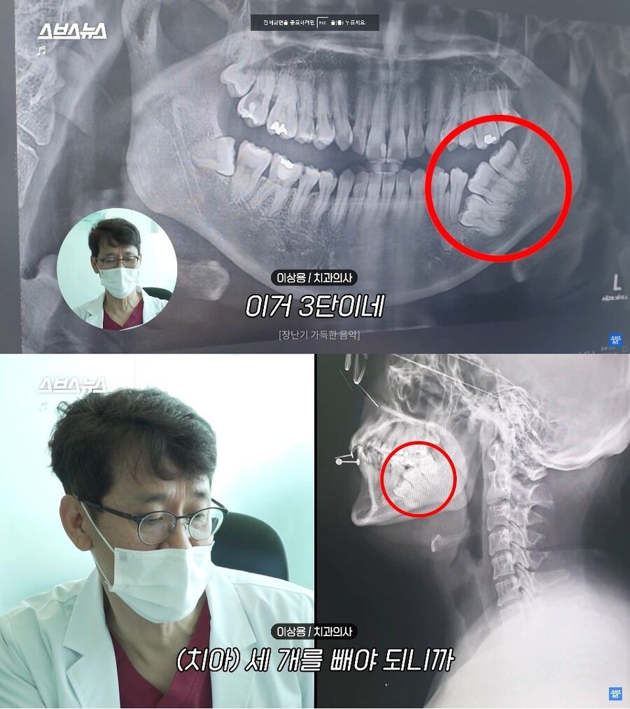 [유머] 전설의 3단 사랑니 -  와이드섬
